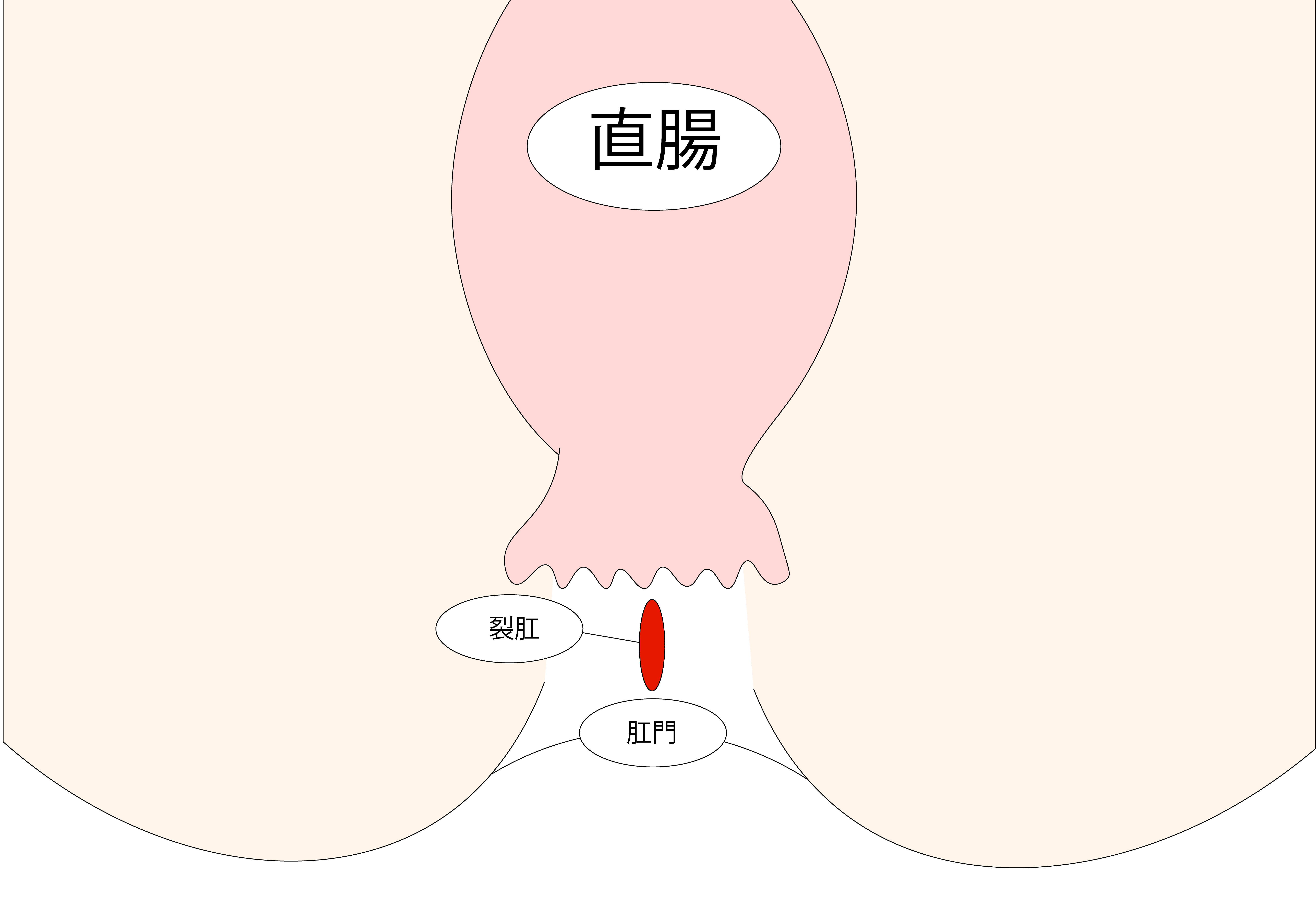 急性裂肛