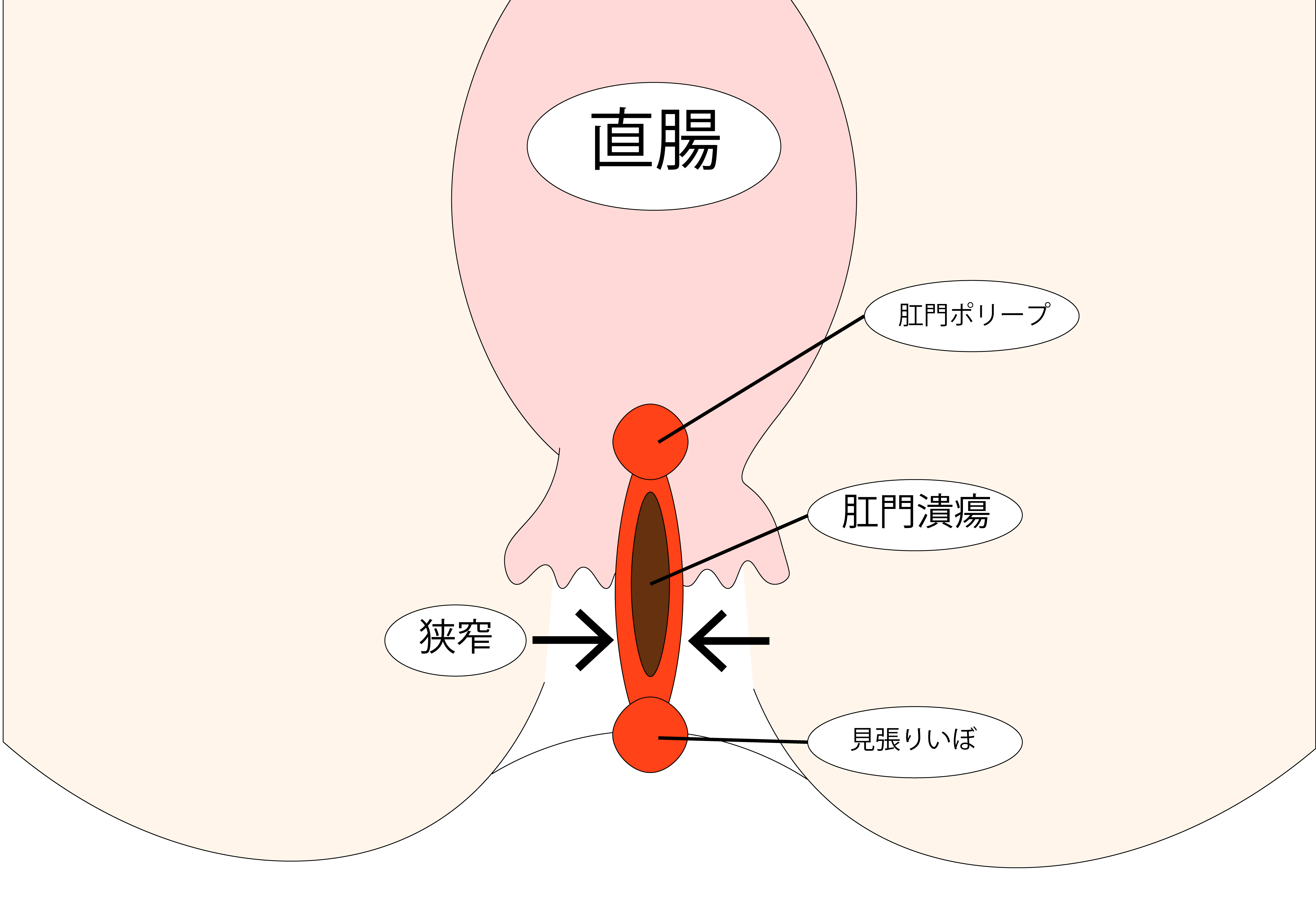 慢性裂肛
