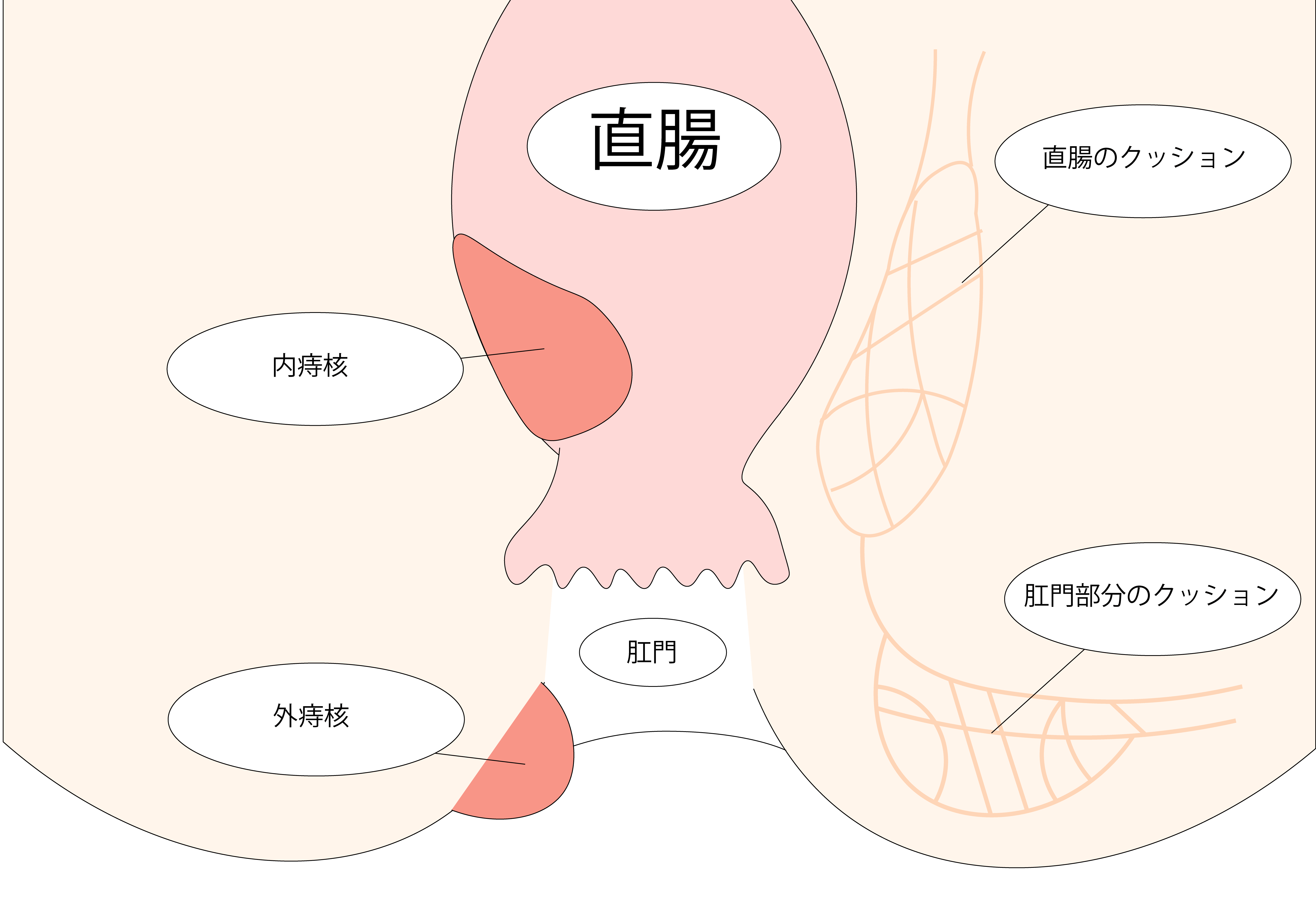 痔核