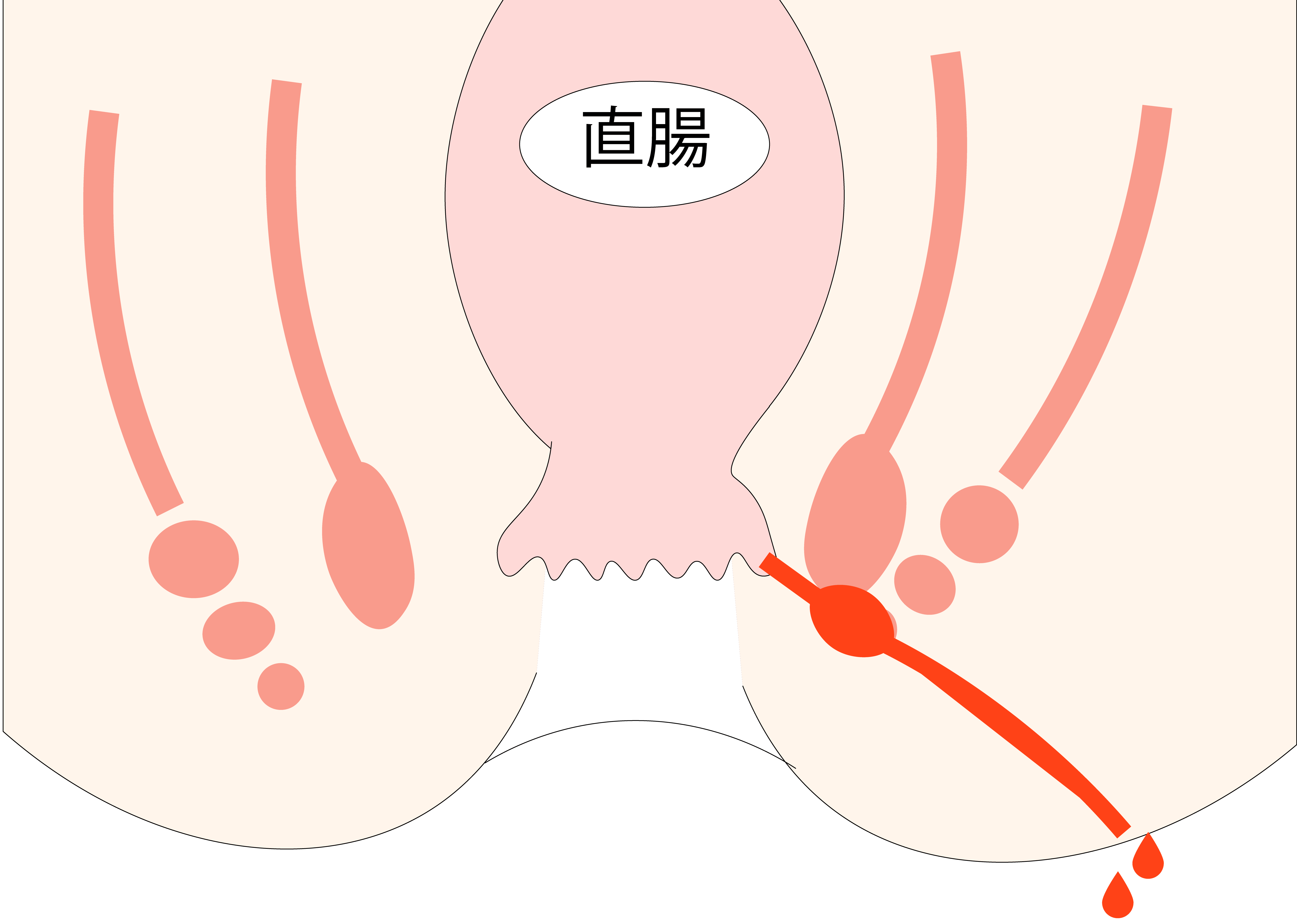 痔瘻