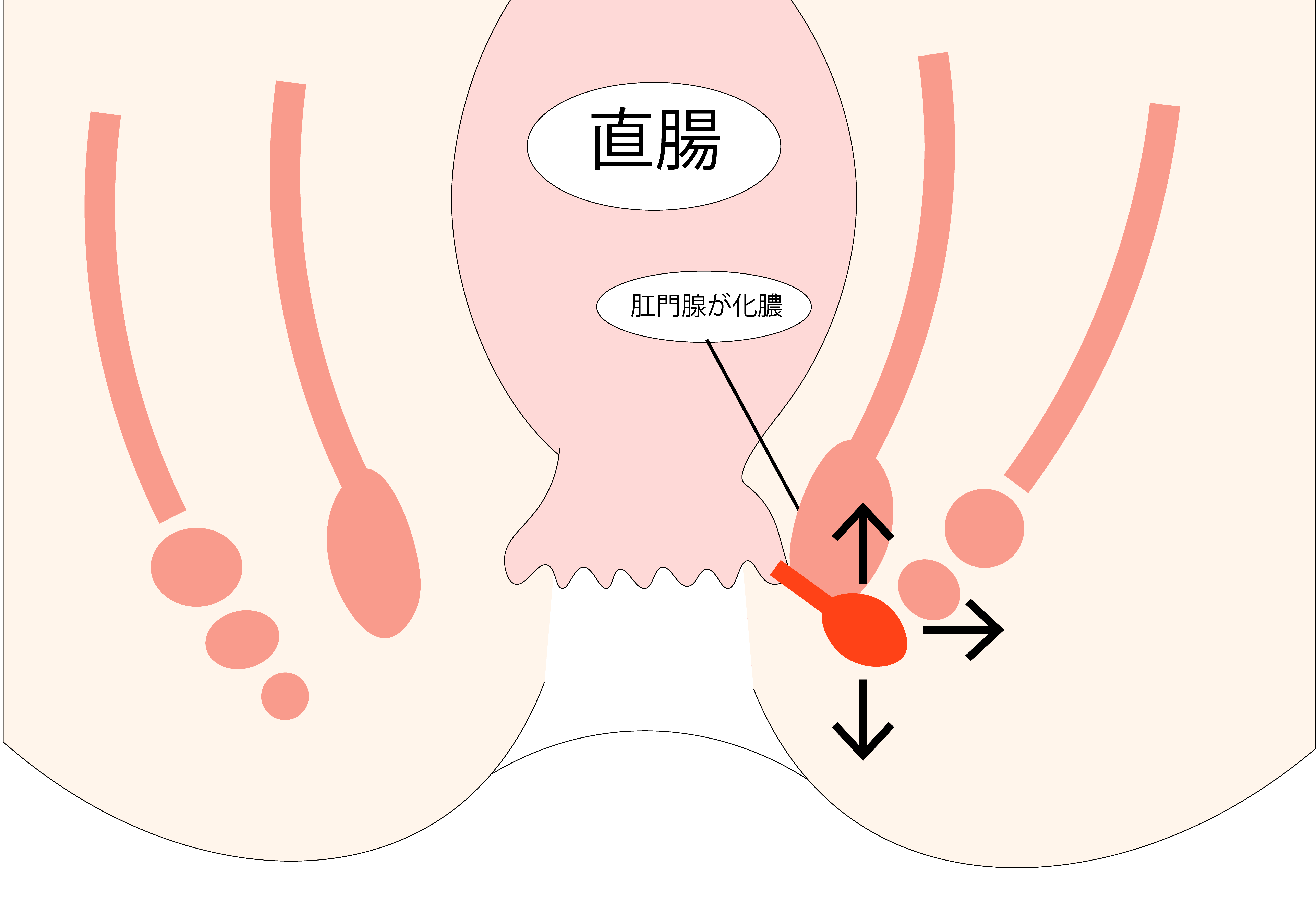 肛門周囲膿瘍